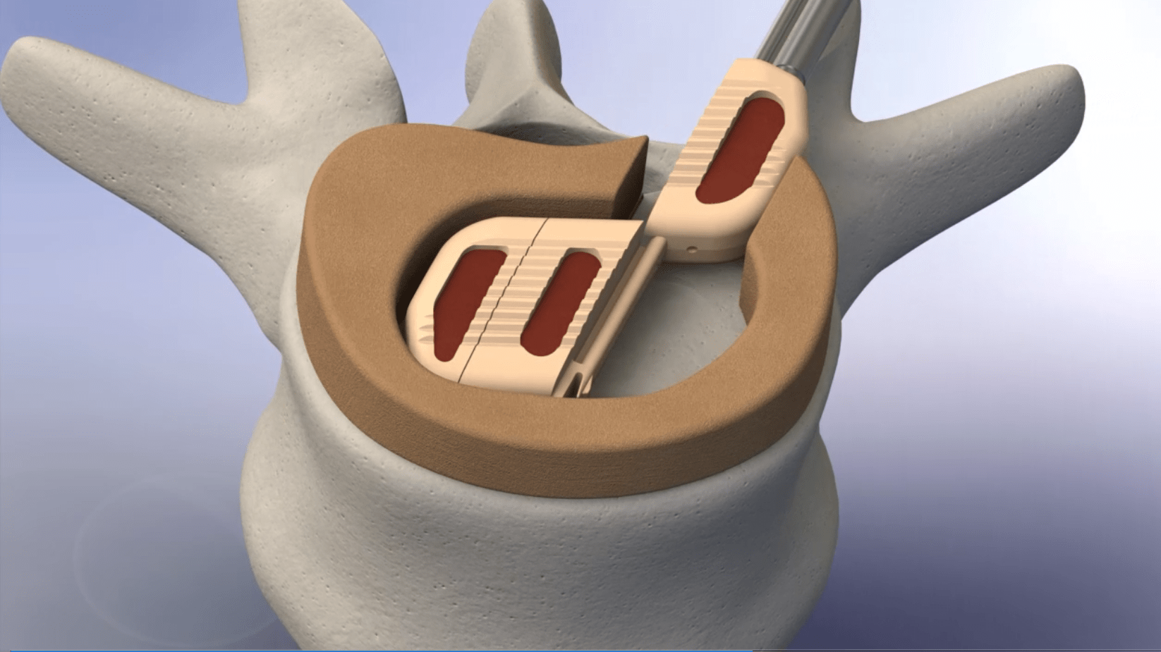 Vertebral Technologies, Inc. Crosses 3,000 Implant Milestone for Market